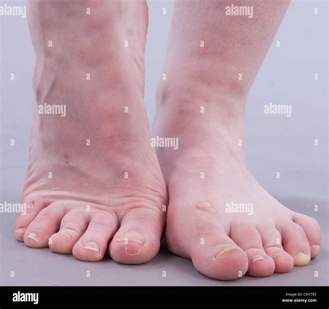 Ugly Feet Pictures, Images and Stock Photos